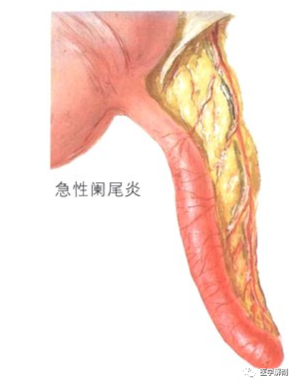 奈特图谱解剖|阑尾及阑尾常见病变