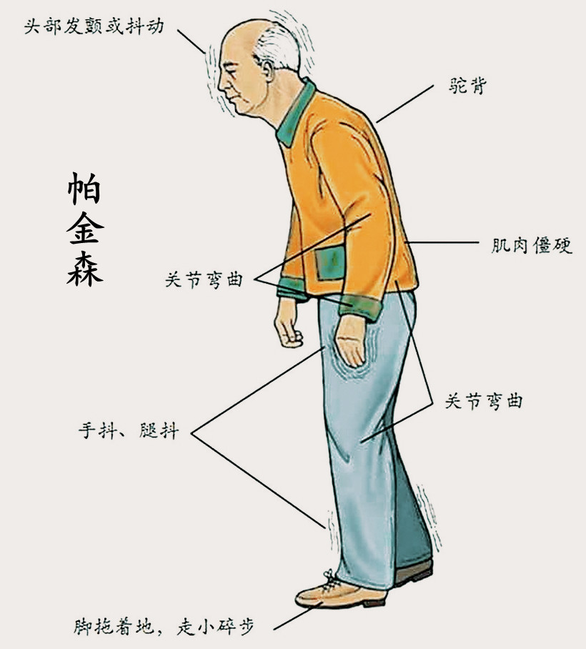 6,强直性脊柱炎