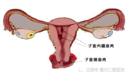 重庆仁爱妇科医院讲解:子宫息肉的危害都有哪些表现