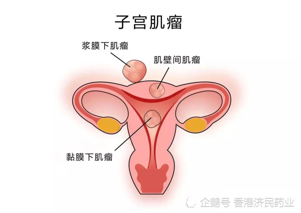 改善月经过多和疼痛子宫肌瘤新药ryeqo复方片在欧盟获批