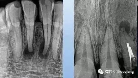 病理及临床:根尖部脓液被纤维组织包围,或由根尖肉芽肿得中央细胞坏死