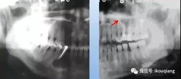 鉴别致密性骨炎临床表现:好发于年青人,常见下颌第一磨牙,常有大龋坏