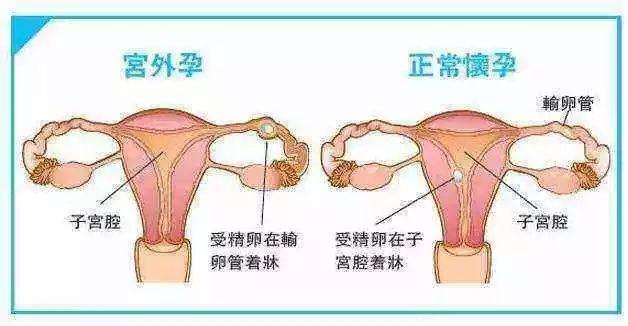 宫外孕早期未发生输卵管妊娠流产或破裂症状一般并不明显