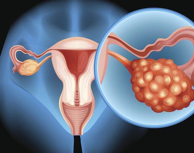 卵巢癌让人们闻之色变,那么卵巢癌在发生的前期有什么症状?