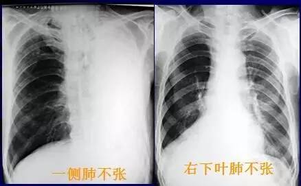 基础篇!肺部常见病变的x线片总结