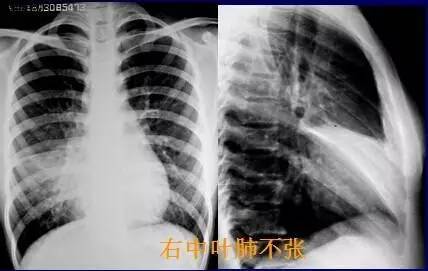 基础篇!肺部常见病变的x线片总结