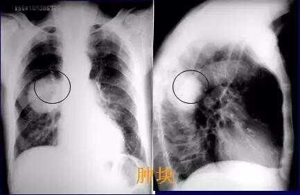 基础篇!肺部常见病变的x线片总结