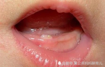 宝宝八个多月了还没长牙,妈妈急的上火了