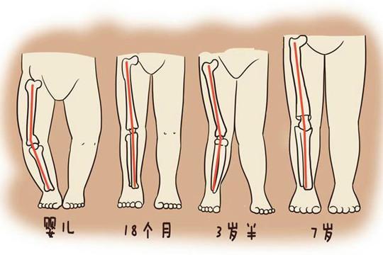 腿不直≠o型腿,宝宝是不是o型腿,应该这样判断!