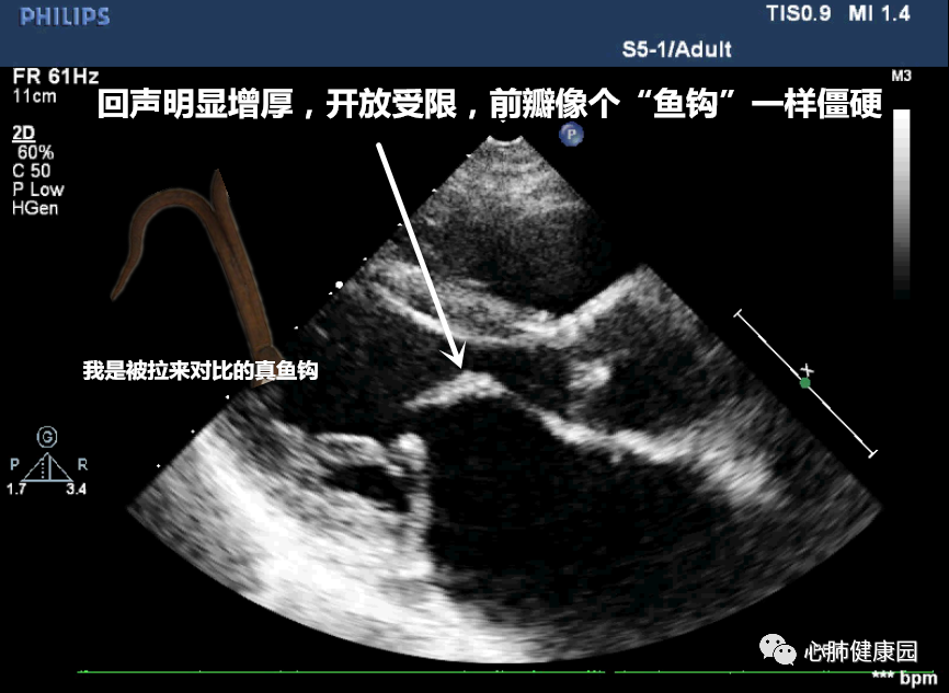 从左室长轴切面切换到左室短轴切面:如图2(a)左所示,正常二尖瓣的瓣口