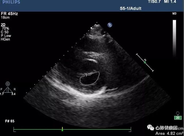 二尖瓣狭窄与二尖瓣关闭不全|心脏彩超报告解读