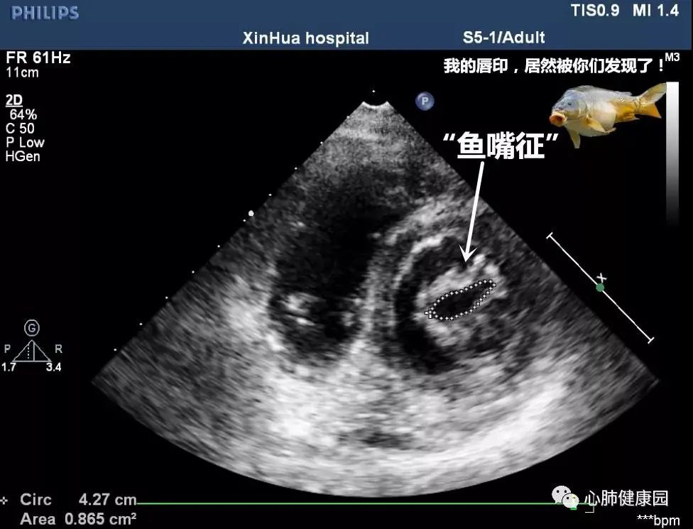 二尖瓣狭窄与二尖瓣关闭不全|心脏彩超报告解读