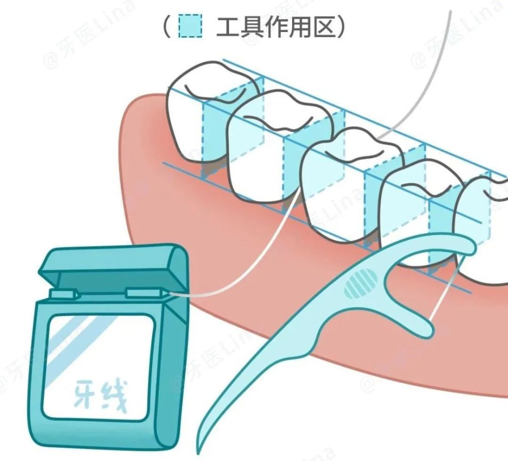 用牙线就出血,是牙线的锅吗?