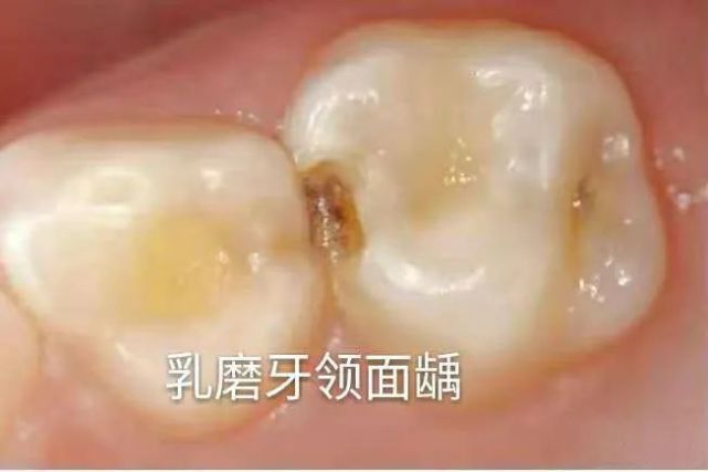 邻面清洁不干净,龋病和牙周病就可能找上门.为什么要用牙线?