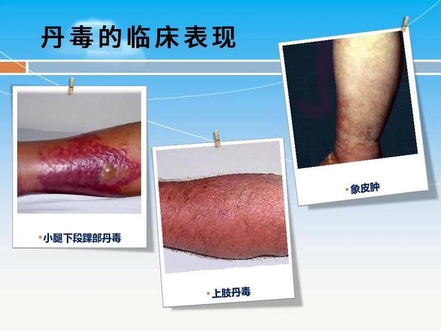 暴雨来势汹汹,当心蹚水诱发丹毒