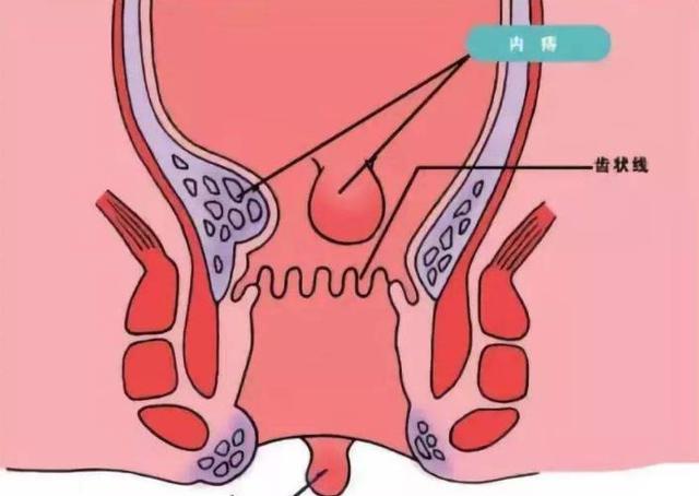 肛门附近长出小肉球别只以为是痔疮也可能是这2种疾病