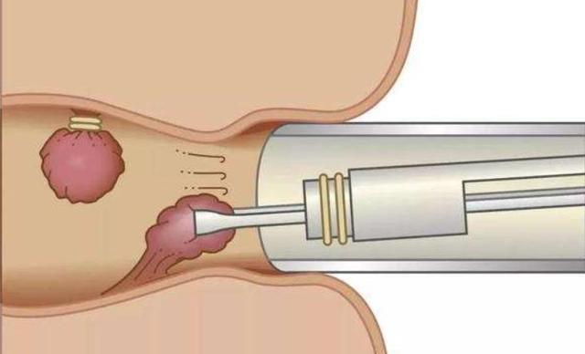 肛门附近长出小肉球别只以为是痔疮也可能是这2种疾病