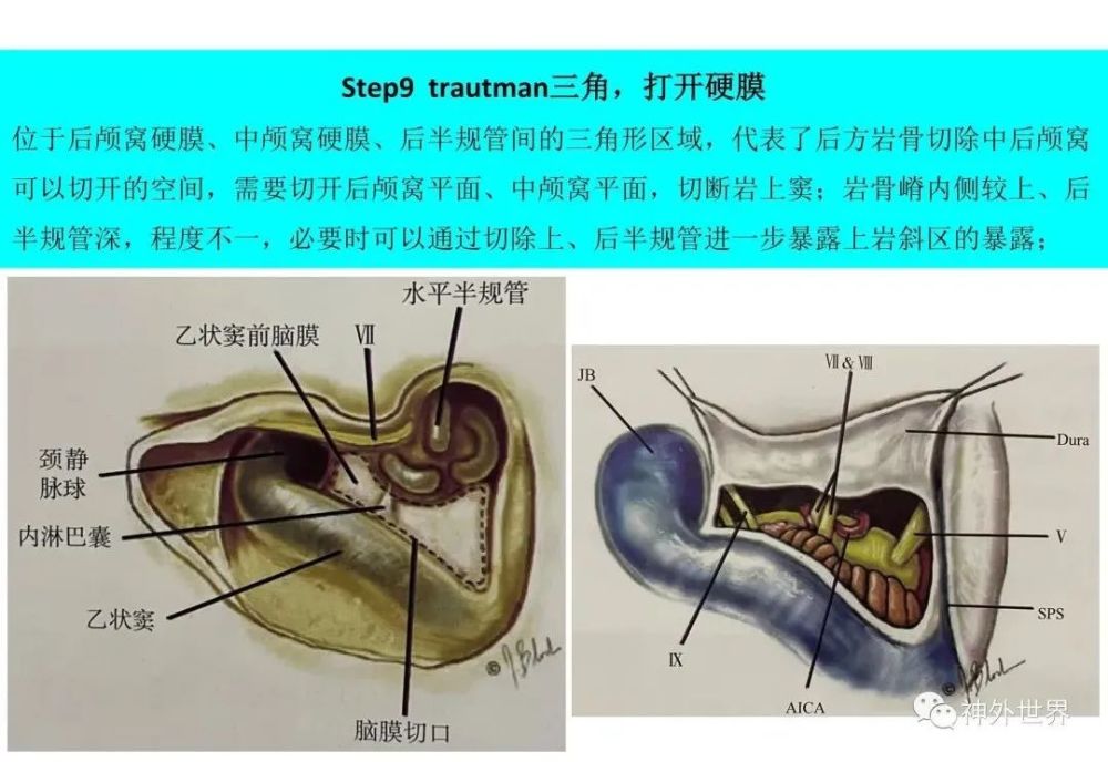 后方经岩骨入路乙状窦前入路显微内镜解剖专栏