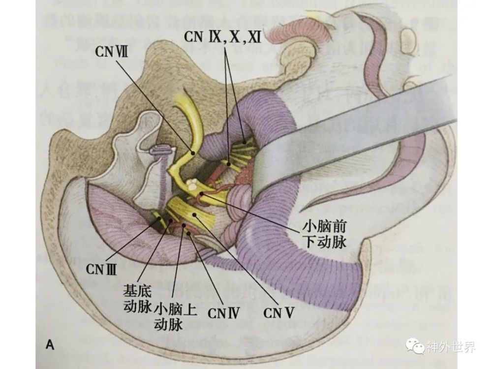 后方经岩骨入路-乙状窦前入路——显微,内镜解剖专栏