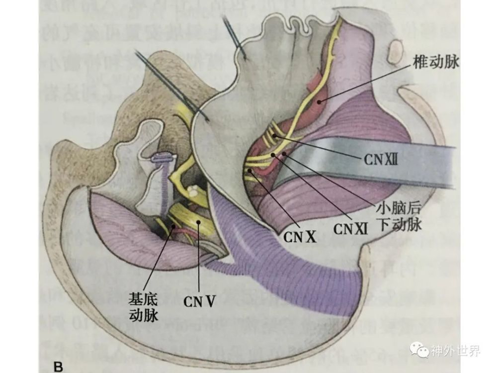 后方经岩骨入路-乙状窦前入路——显微,内镜解剖专栏