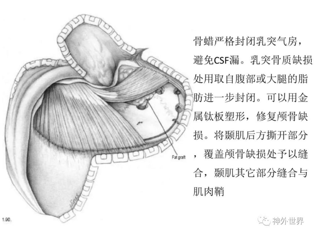 后方经岩骨入路-乙状窦前入路——显微,内镜解剖专栏