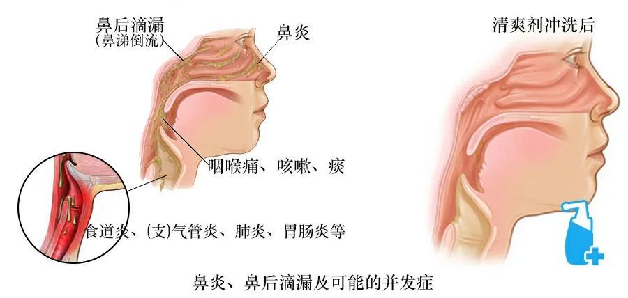 引起鼻后滴漏综合征的常见疾病有哪些?