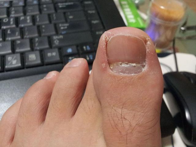 脚趾甲总往肉里"钻"是咋回事?如何改善这种症状?早知道早受益