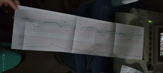 诊疗经过:患者宫口开大 2   cm 时行分娩镇痛,观察过程中胎心监护