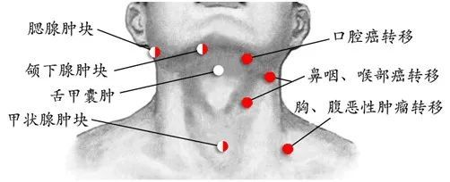 颈正中部常见肿物:颏下淋巴结炎/转移癌,甲状舌管囊肿,甲状腺结节等.