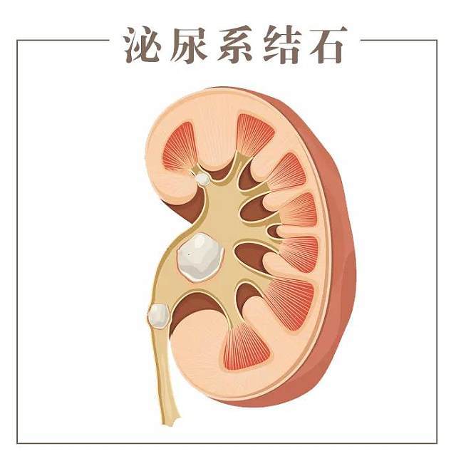 胆结石肾结石胃结石身体里哪来这么多石头