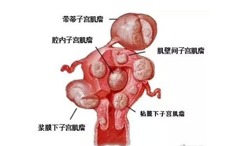 【上海济德正兴中医】什么是子宫肌瘤?子宫肌瘤要不要切呢?