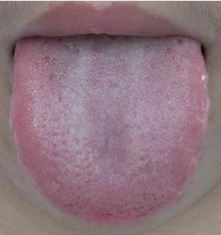 舌苔中间有裂纹是大病的征兆?辟谣:可能不是病理原因