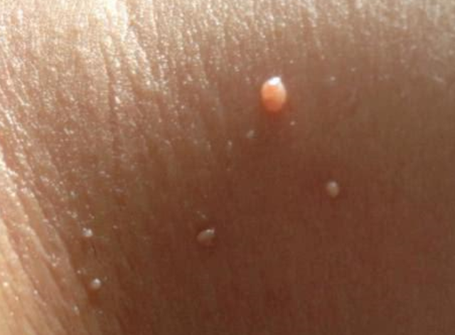皮赘:皮赘也被称为软纤维瘤,主要是皮肤局部组织出现增生物后的表现.