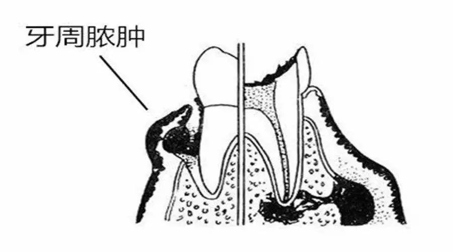 8,牙龈乳头炎临床表现:自发性胀痛,可有冷热刺激反应,有食物嵌塞史,临