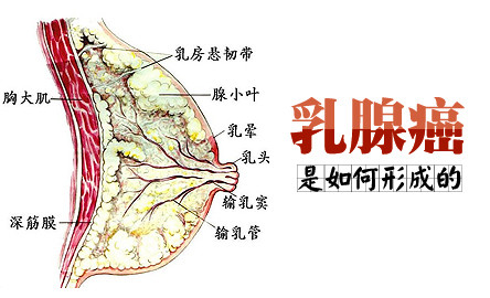 乳腺癌:女性健康"头号杀手"