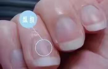 指甲有竖纹是身体的什么信号（指甲有竖纹是身体的什么信号图片）