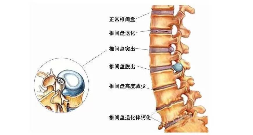 杭吉干细胞科技干细胞移植改善椎间盘退变的研究现状及临床案例