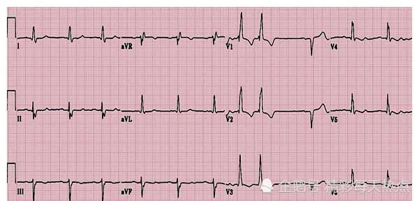 可心电图正常,这该怎么办?医生教你