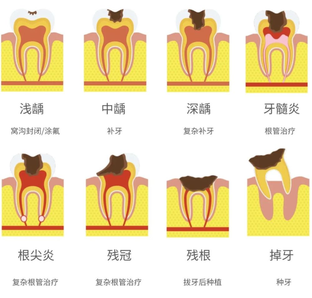 我只想补个牙,医生却非让我做"根管治疗"