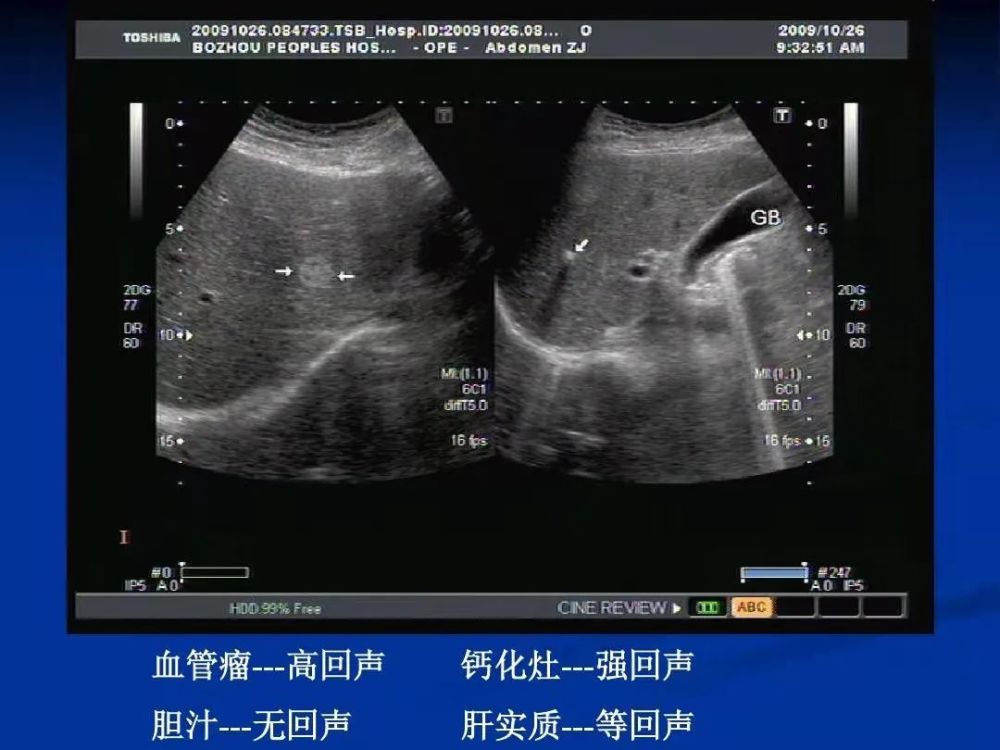 不少人b超ct提示有肝内钙化灶到底是什么意思