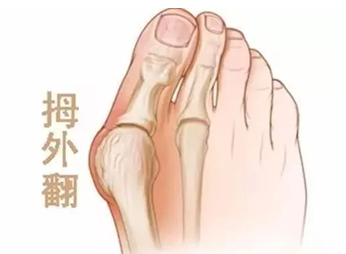 【专家谈病】脚疼非小事,警惕拇外翻!你的脚还好吗?
