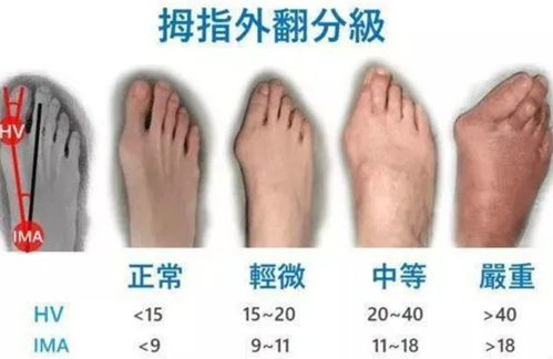 拇外翻严重阶段:大拇指外翻20-40度,脚趾重叠,横弓塌陷