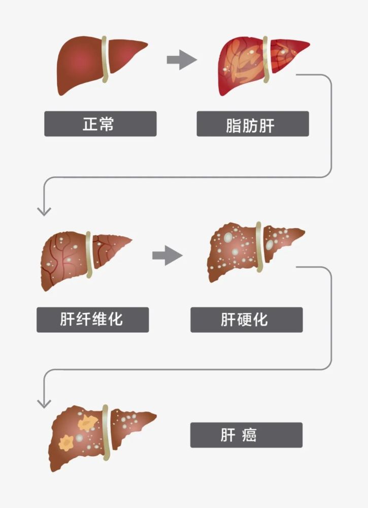 正在透支身体的脂肪肝,到底离肝癌有多远?