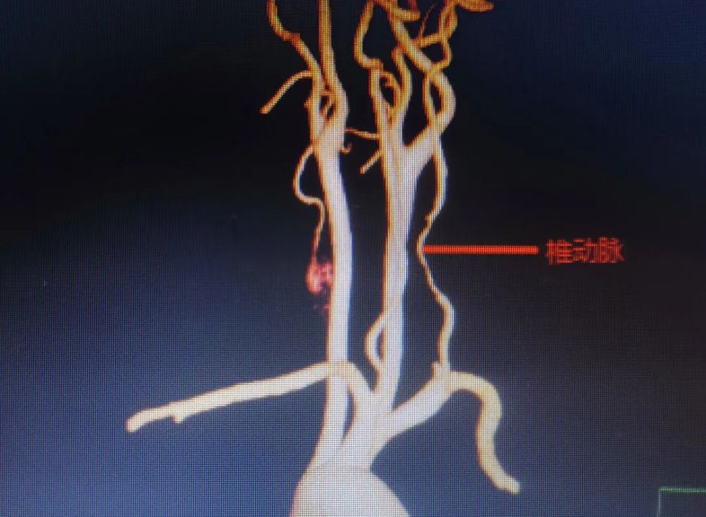 脖子上长鹅蛋大肿块压迫血管神经,多学科联合切除巨大神经鞘瘤