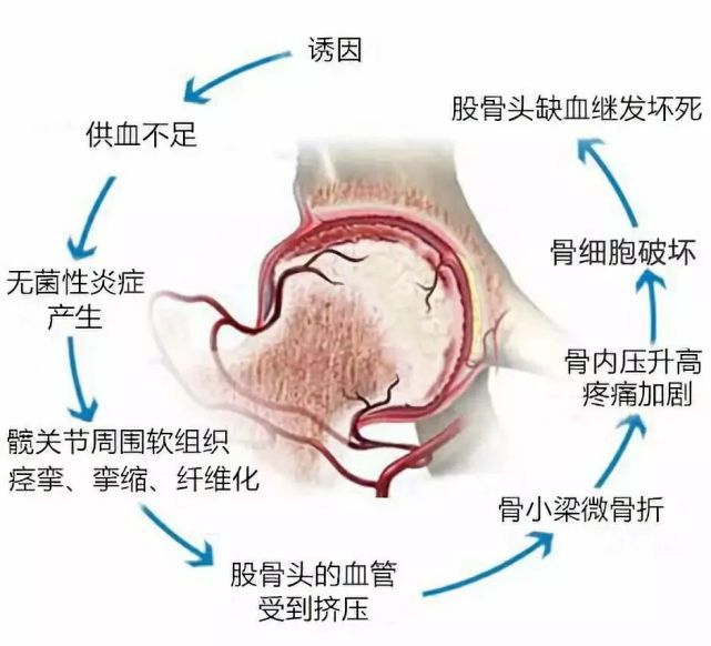 膝盖总疼为什么说是股骨头坏死?