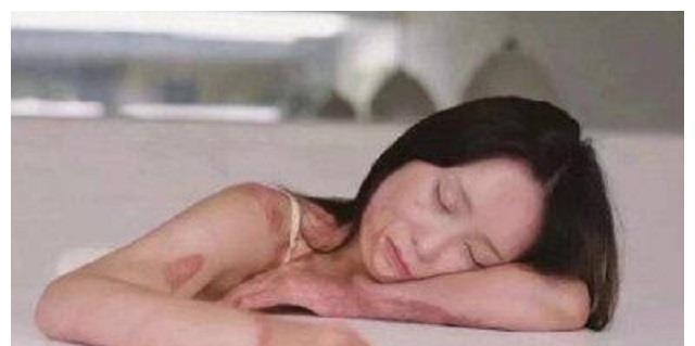 安徽女孩周岩,因拒绝富二代追求被泼汽油,如今走出来了吗?