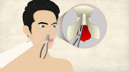 暨南大学崇爱医院耳鼻喉科秦伟医师分析鼻骨骨折怎么