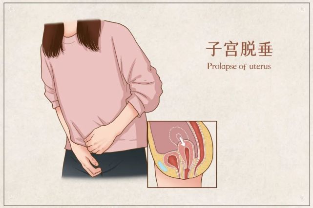 子宫也会"掉"下来?