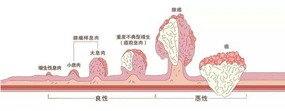 【科普】内镜科为您解答,肠息肉会变成肠癌吗?