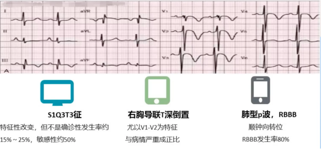 易漏诊,误诊的肺栓塞心电图特点